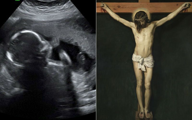 Pregnant Woman's Sonogram Depicts Jesus Crucified - See the Miraculous Photo!